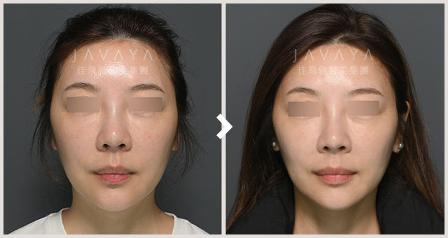 【海芙電音雙波】療程後三個月 前後對比-小嫚